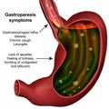 Gastroparesis stomach medical illustration on white background