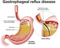 Gastrophageal reflux disease (GERD). Illustration. Labeled