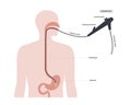 Gastroscopy endoscopy procedure Royalty Free Stock Photo