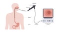 Gastroscopy endoscopy procedure