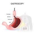 Gastroscopy, Esophagoscopy and duodenoscopy Royalty Free Stock Photo