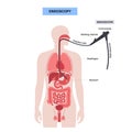 Gastroscopy endoscopy procedure