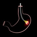 Gastroscopy procedure. Human stomach with Peptic ulcer, and endoscopic device