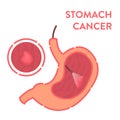 Stomach cancer detected by endoscopy medical procedure Royalty Free Stock Photo