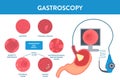 Gastroscopy procedure of stomach examination with endoscope