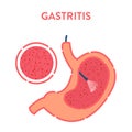 Stomach gastritis detected by endoscopy medical procedure