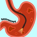 Gastroscopy, research of a stomach gastroscope. Royalty Free Stock Photo