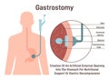 Gastrostomy. Gastric inserted feeding tube, food nutritions injecting