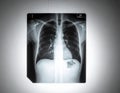 A chest X-ray image showing the thoracic region of a human body Royalty Free Stock Photo