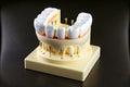 generic dental implant study analysis crown bridge demonstration teeth model