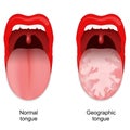 Geographic tongue. Benign migratory glossitis