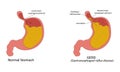 Gastroesophageal reflux disease(GERD) vector illustration Royalty Free Stock Photo