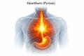 GERD Acid Reflux Pyrosis 3D visualization features translucent torso with fiery glow rising from stomach through esophagus behind Royalty Free Stock Photo