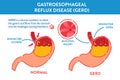 GERD stomach acid reflux disease infographic medical poster Royalty Free Stock Photo