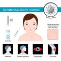 German measles. infographics about symptoms of Rubella