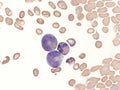 Giant metamyelocytes in a case of megaloblastic anemia, Royalty Free Stock Photo