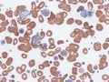 Giant platelets in peripheral blood.