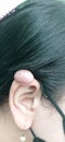 Giants Keloid in Ear Royalty Free Stock Photo