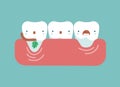 Gingival recession ,dental concept Royalty Free Stock Photo