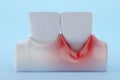 Gingival Recession teeth and gums