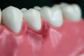 Gingivitis and dental model Royalty Free Stock Photo