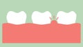 Gingivitis or gum disease, gum inflammation before periodontal disease