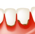 Gingivitis. Inflammation of the gums. Dental calculus. Infographics. Vector illustration on isolated background