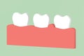 Gingivitis or periodontal disease, inflammation of the gum tissue around the teeth
