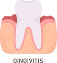 Gingivitis Tooth Problem