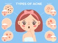 Girl with acne. Young unhappy female face with skin problems and pimple types icons. Dermatology and cosmetic skin care vector Royalty Free Stock Photo