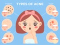 Girl with acne. Young unhappy female face with skin problems and pimple types icons. Dermatology and cosmetic skin care