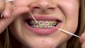 Girl with braces brushing your teeth with dental floss closeup. A girl with colored braces on her teeth keeps her teeth Royalty Free Stock Photo