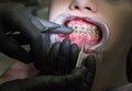 The girl with braces on reception at the dentist-orthodontist. Close-up. Hands in black glove with a tool at the patient`s teeth