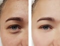 Girl eye treatment, before and after procedures, acne Royalty Free Stock Photo