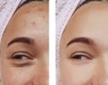 Girl eye treatment closeup , removal health before and after procedures, therapy acne Royalty Free Stock Photo