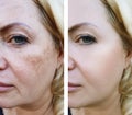 Girl face wrinkles before and after, cosmetic pigmentation Royalty Free Stock Photo