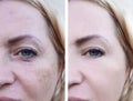 Girl face wrinkles before and after, pigmentation Royalty Free Stock Photo