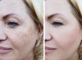 Girl face wrinkles before and after, correction cosmetic lifting pigmentation Royalty Free Stock Photo