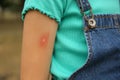 Girl with insect bite on arm outdoors, closeup Royalty Free Stock Photo