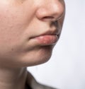Girl lips affected by herpes Royalty Free Stock Photo
