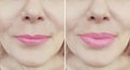 Girl lips before and after augmentation difference  injection Royalty Free Stock Photo