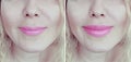 Girl lips before and after augmentation Royalty Free Stock Photo