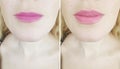 Girl lips before and after augmentation injection Royalty Free Stock Photo