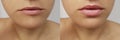 Girl lips, syringe injection, lip augmentation correction before and after procedure collagen s