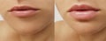 Girl lips, syringe injection, lip augmentation correction before and after procedures