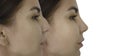 Girl nose hump before and after treatment clinic