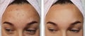 Girl pimples on the forehead before and after procedures