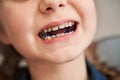 Girl with plates being examined by dentist at clinic Royalty Free Stock Photo