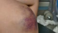 Agirl rubs her fingers with a curative ointment in a bruised knee