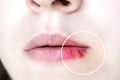 Girl's lips affected by herpes. Royalty Free Stock Photo